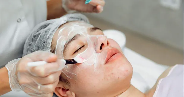 Chemical Peel_1_11zon
