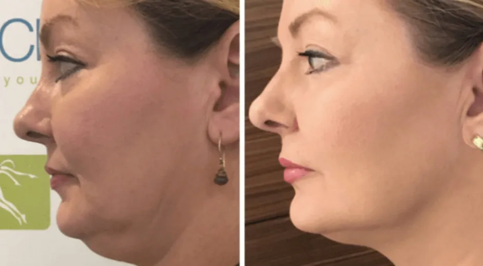 Ultherapy (UltraLift)_6_11zon